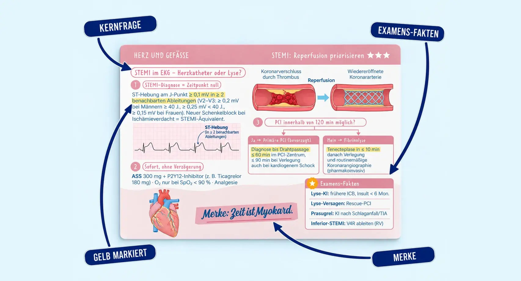 Lernkarte zu STEMI mit Kernfrage, gelb markierten Kernaussagen, Examens-Fakten-Kasten und Merke